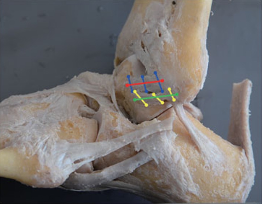 Anatomic Measurement and Variability Analysis of the Anterior Talofibular Ligament and Calcaneofibular Ligament of the Ankle