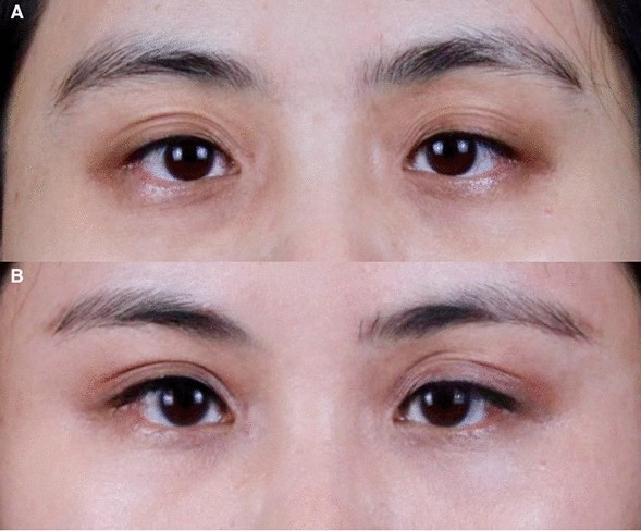 Correction of infraorbital dark circles using autologous adipose-derived collagen.